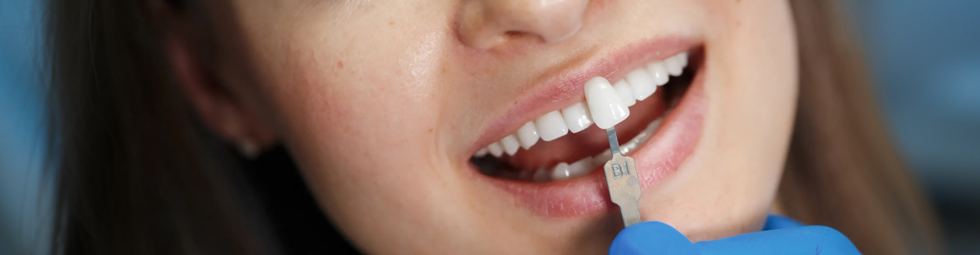 Dentist using a shade guide to match porcelain veneers to natural patient teeth color.